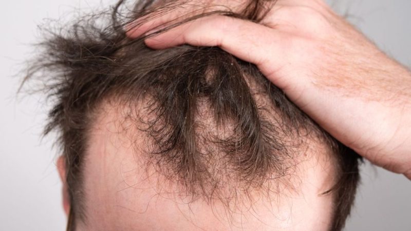 علاج صلع مقدمة الرأس عند الرجال | 8 أسباب لتراجع خط الشعر