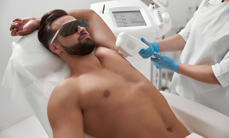 إزالة الشعر بالليزر للرجال